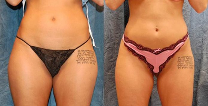 Liposuction