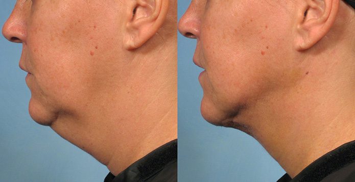 Skin Tightening