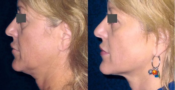 Liposuction