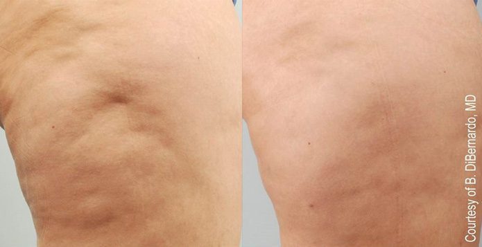 Facial Rejuvenation