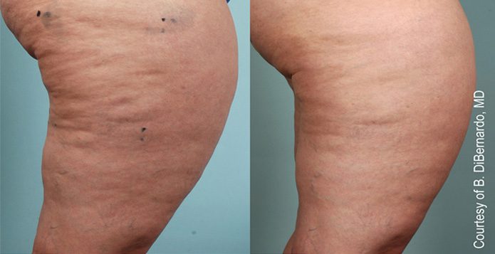 Skin Tightening
