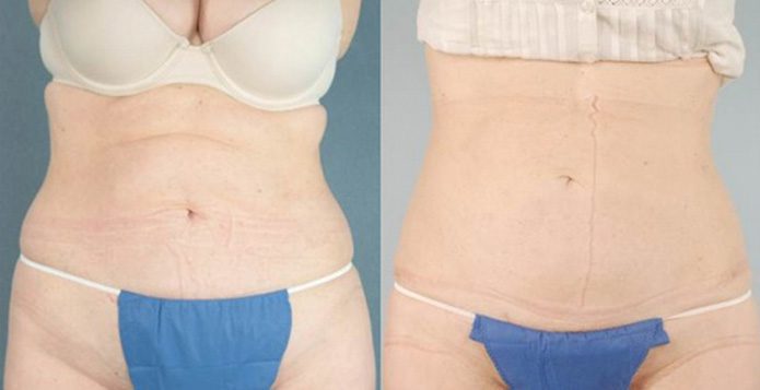 Liposuction
